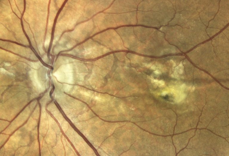 angioid streaks_eyeDx